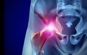 hip osteoarthritis and replacement