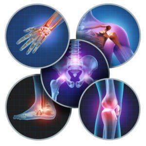 Computerized image of different types of arthritis