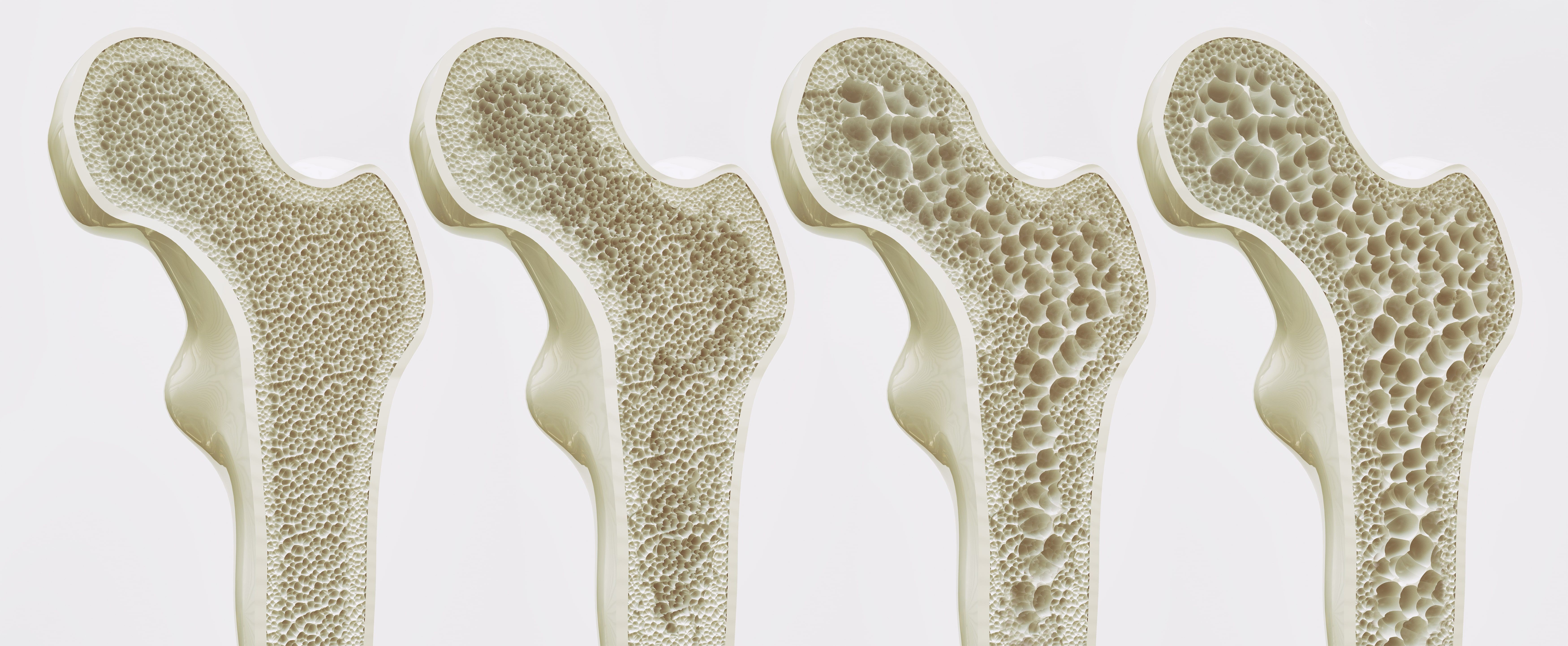 The Bone Density Test - Space Coast OrthopedicMerritt Orthopedics