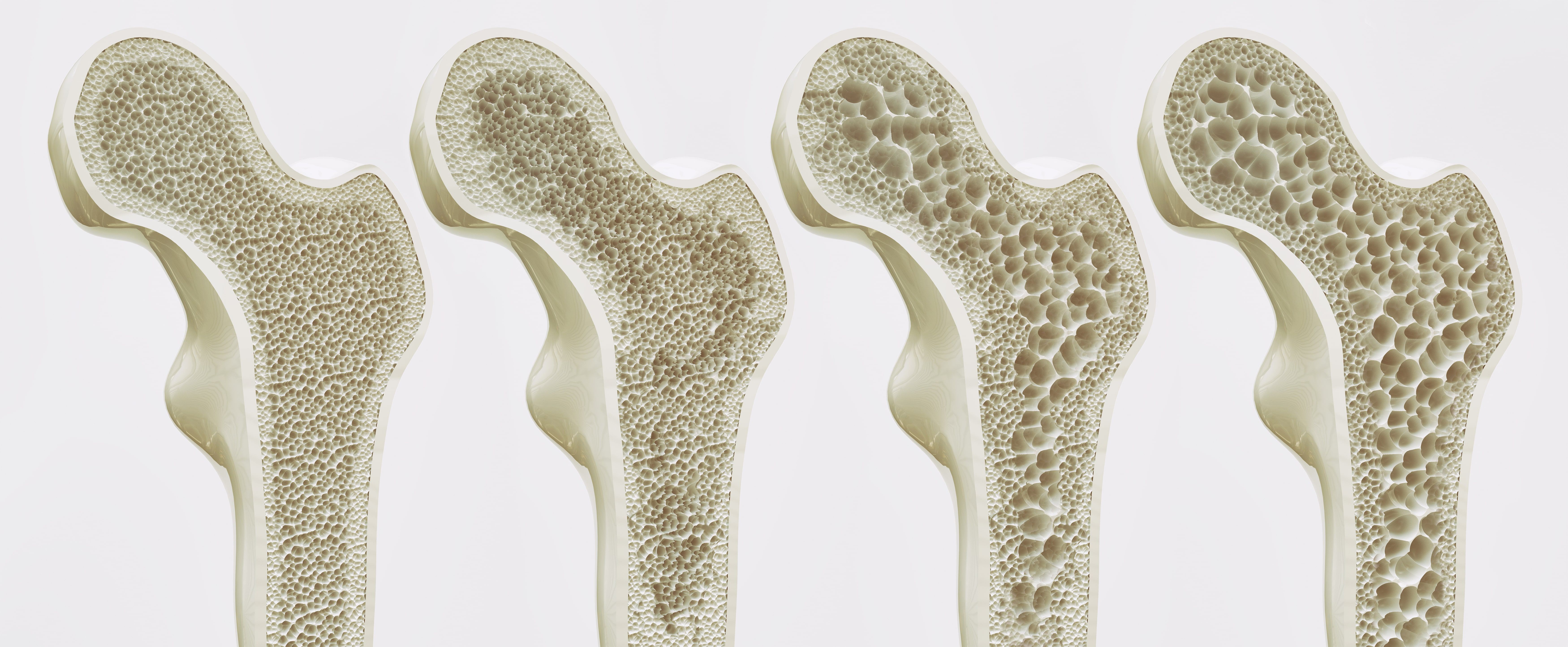 The Bone Density Test Space Coast OrthopedicMerritt Orthopedics 
