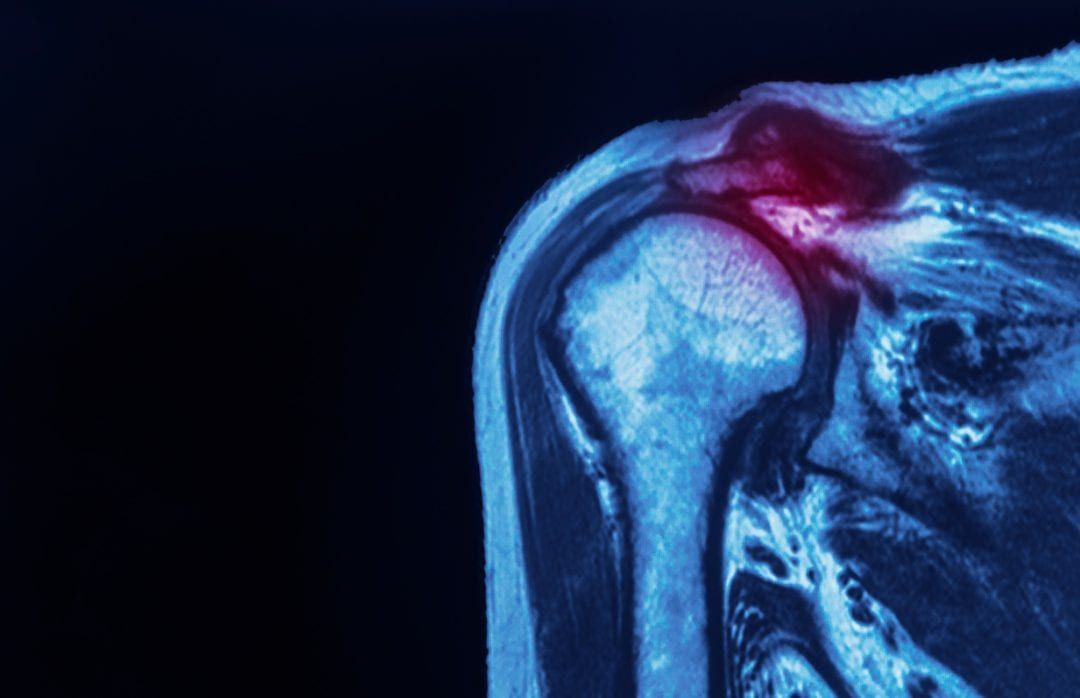 Injuries That Can Affect Your Rotator Cuff Space Coast OrthopedicMerritt Orthopedics Merritt