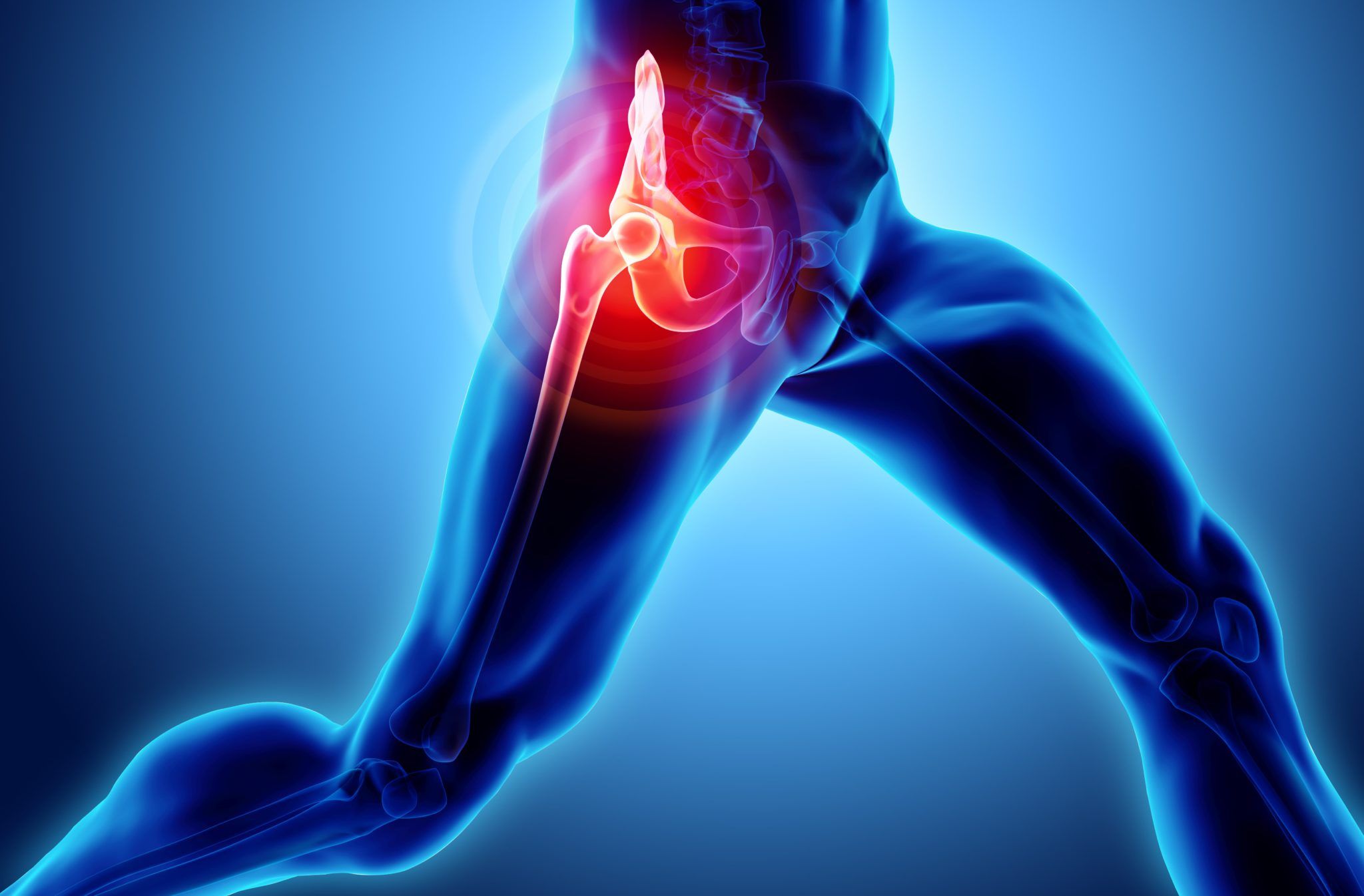 Signs You May Need a Hip Replacement - Space Coast OrthopedicMerritt ...