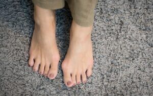 Woman with bunions on her feet