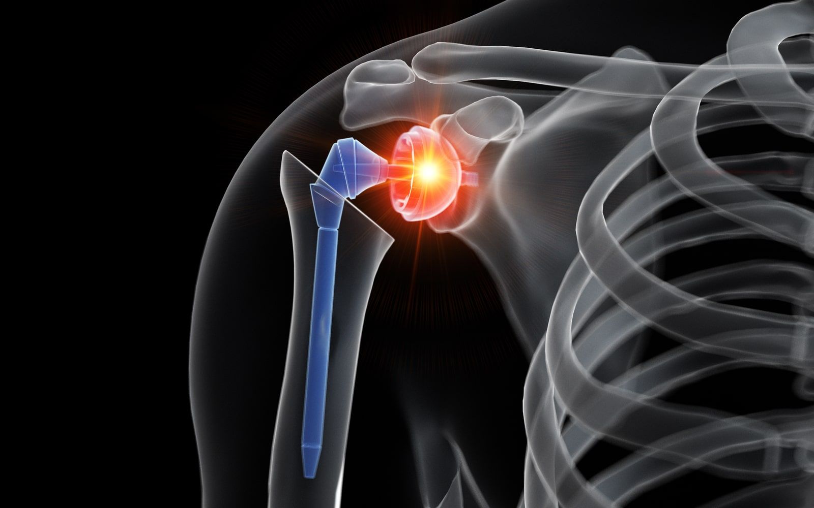 Improved Shoulder Replacements With Computer Assistance Space Coast