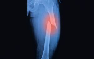 Femur Fracture X-Ray